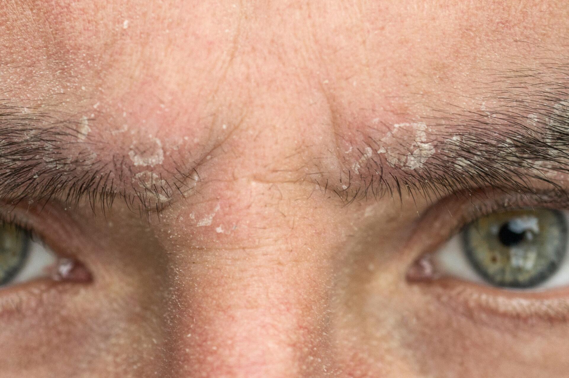 Symptômes des pellicules dans les sourcils